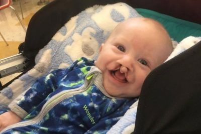 5-Month-Old Baby With Cleft Palate Smiles for First Time as Mom Documents Struggle