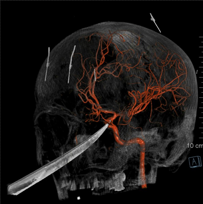 3D imagery of Eli Gregg's skull with a knife embedded