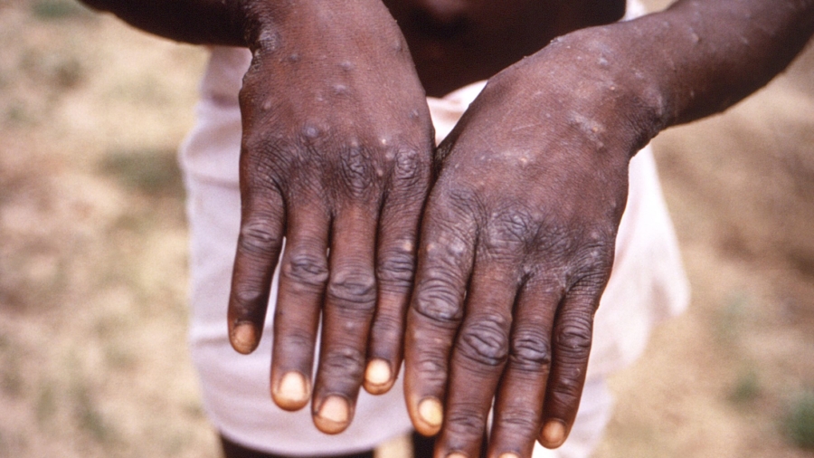 Monkeypox Outbreak Primarily Spreading via Sexual Contact: WHO Officials